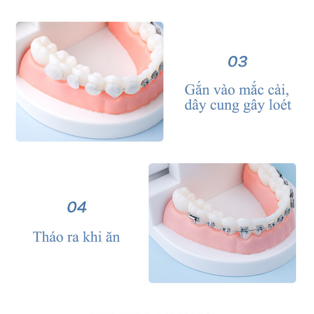 Sáp nha khoa YGate - cho niềng răng