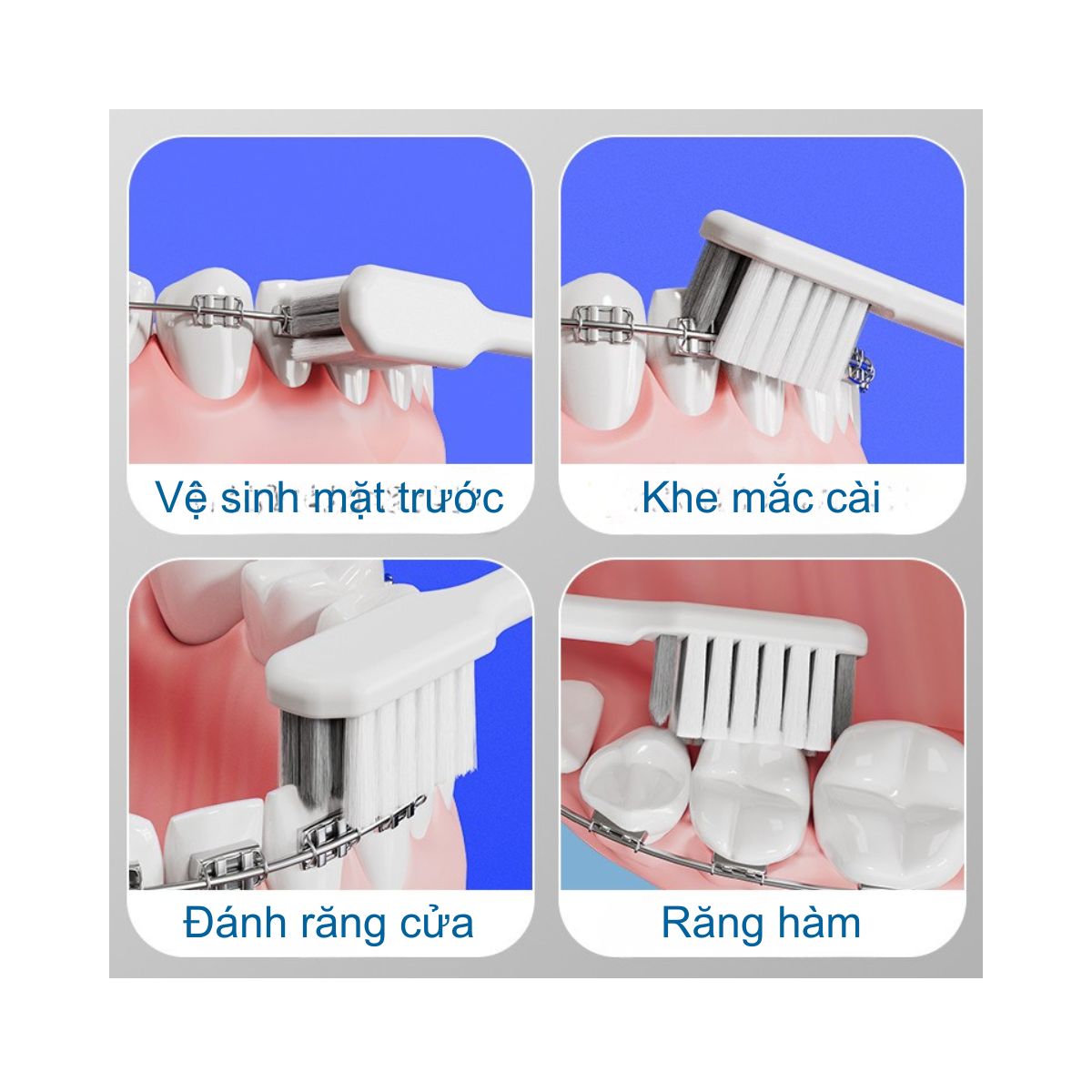 Bàn Chải Đánh Răng Cho Niềng Răng Mắc cài - Gấp Gọn – Lông Mềm Thiết Kế Chữ U Chuyên Dụng ChenKe