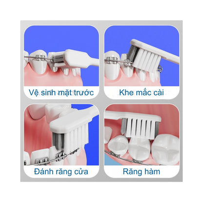 Bàn Chải Đánh Răng Cho Niềng Răng Mắc cài - Gấp Gọn – Lông Mềm Thiết Kế Chữ U Chuyên Dụng ChenKe