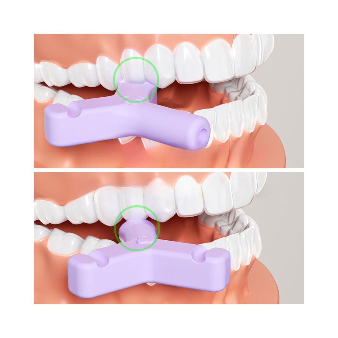 Miếng Cắn Chỉnh Nha Chewies Hình Chữ Y Làm Khít Khay Niềng Răng Trong Suốt Invisalign, Zenyum