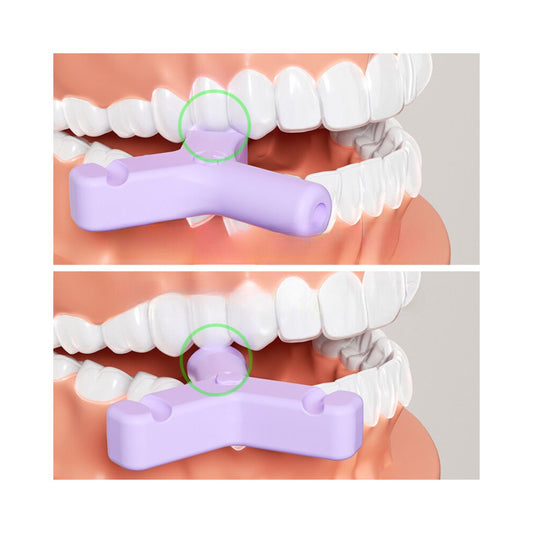 Miếng Cắn Chỉnh Nha Chewies Hình Chữ Y Làm Khít Khay Niềng Răng Trong Suốt Invisalign, Zenyum
