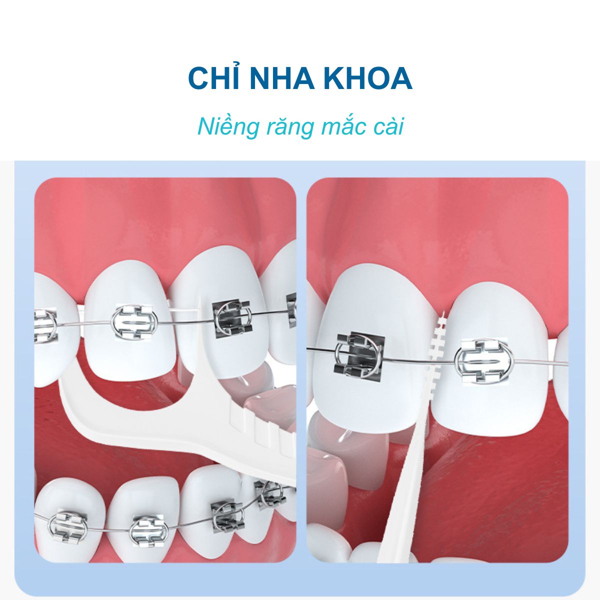 Tăm Chỉ Nha Khoa Cho Người Niềng Răng Mắc Cài (Thiết Kế 2 Đầu Tích Hợp Bàn Chải Kẽ)